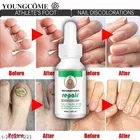 Onychomycosis Nail Serum 