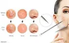 4-Piece Blackhead & Acne Removal Needle Kit For Blemish, Pimple, and Pore Cleaning