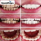 Smartdrops Teeth Whitening Foam 
