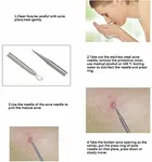 4-Piece Blackhead & Acne Removal Needle Kit For Blemish, Pimple, and Pore Cleaning