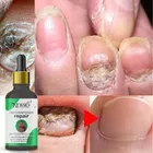 Newsio Nail Fungus Treatment Oil (30 ml)