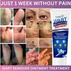 Wart Remover Cream, Massa Removal Cream 