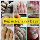 Onychomycosis Nail Serum 