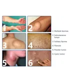 Feminela Lipoma Remover Spray 